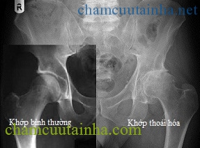 Bệnh thoái hóa khớp háng