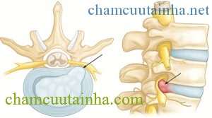 Thuốc nam chữa bệnh thoát vị đĩa đệm