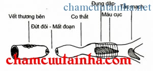 Vết thương mạch máu