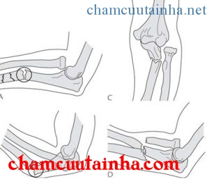 Phân loại gãy Monteggia