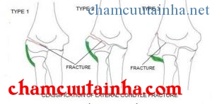 Phân loại theo sự di lệch