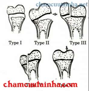 Gãy bong sụn tiếp ở trẻ con