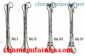 Phân loại gãy thân xương đùi