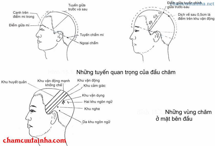 phương pháp đầu châm trong châm cứu