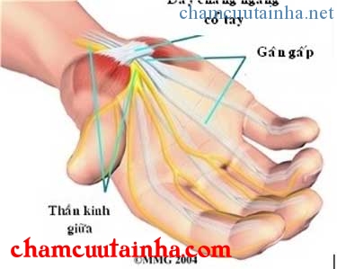 hội chứng ống cổ tay và cách điều trị