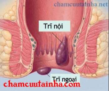 Hình ảnh vị trí bệnh trĩ nội, trĩ ngoại