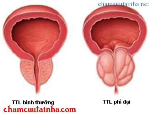 Phì đại tiền liệt tuyến theo y học cổ truyền 1