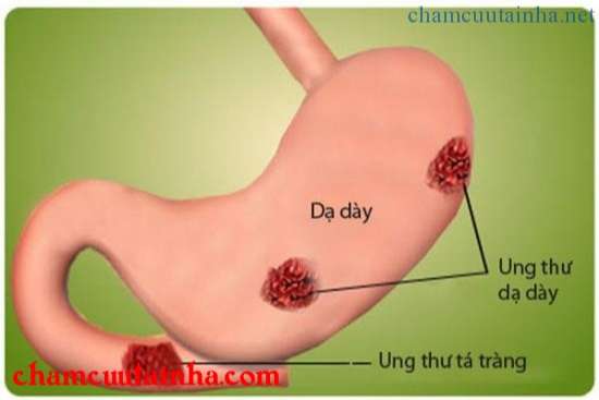 Các phương pháp phòng chống Ung thư dạ dày 1