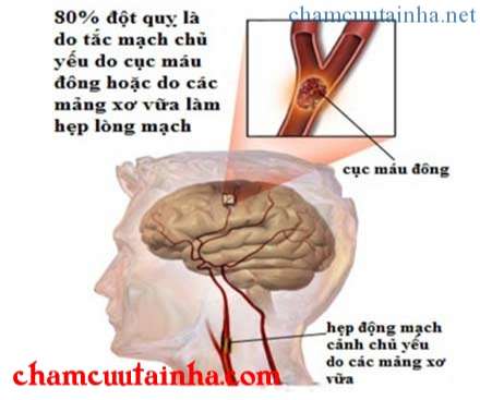 Bệnh tai biến mạch máu não