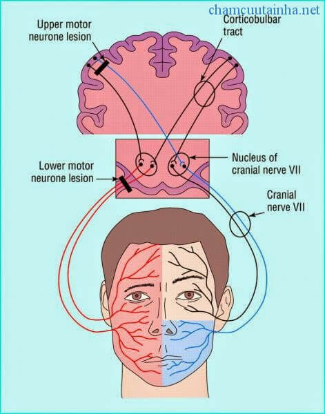 Cơ chế của liệt mặt TW và ngoại biên