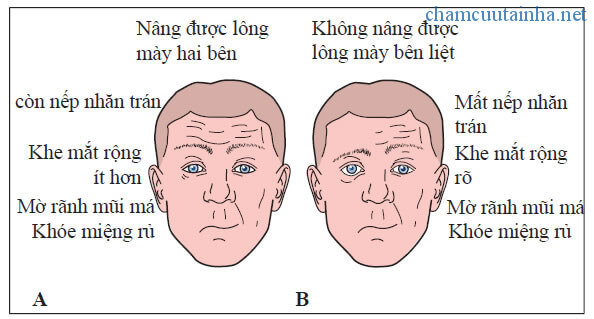 Cơ chế của liệt mặt TW và ngoại biên