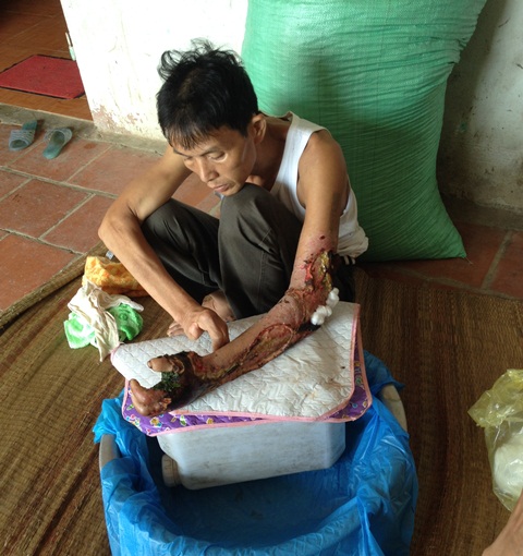 Ông Lương Quang Thắng, người xã Lương Sơn bị rắn hổ mang cắn vào tay đã được chữa khỏi