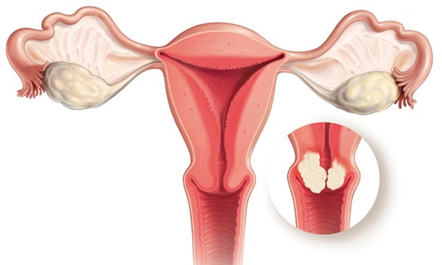 Hình ảnh khối u trong cổ tử cung (Ảnh minh họa)