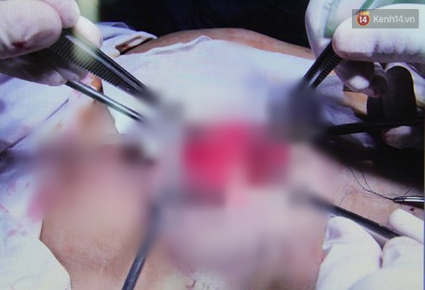 Tiêm silicon dạo, một phụ nữ bị hỏng cả ngực và mặt.