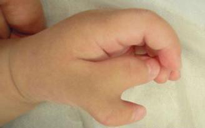 Hình ảnh một bàn tay của em bé có tới 6 ngón.