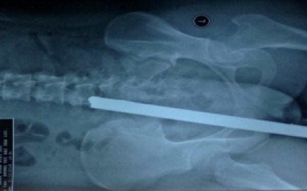 dị vật, thanh sắt đâm vào người, bệnh viện Việt Đức